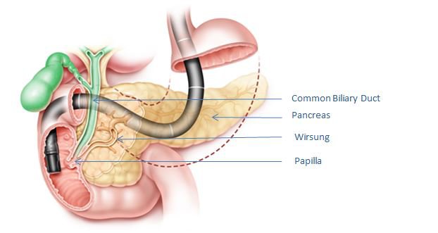 ERCP