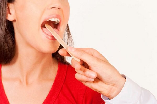 Viêm họng mãn tính kéo dài dai dẳng, dễ tái phát Viêm họng mãn tính kéo dài dai dẳng, dễ tái phát