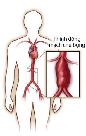 Phình động mạch chủ bụng