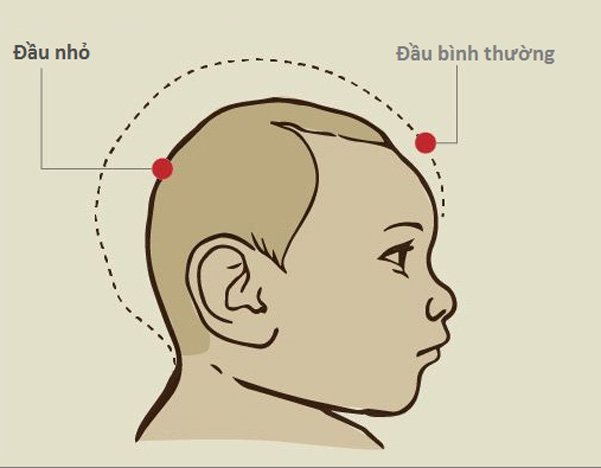 Ngạt khi sinh: Những biến chứng nguy hiểm Ngạt khi sinh: Những biến chứng nguy hiểm