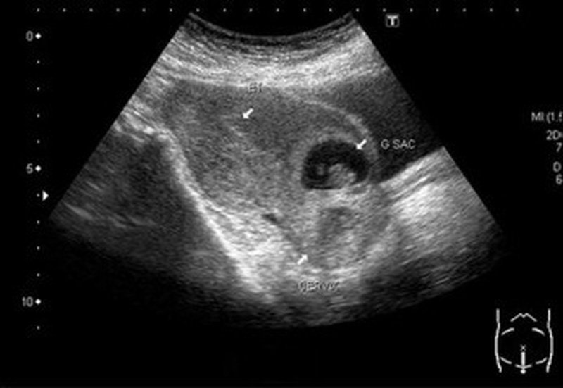 Nguy hiểm khi chửa tại vết mổ đẻ cũ Nguy hiểm khi chửa tại vết mổ đẻ cũ