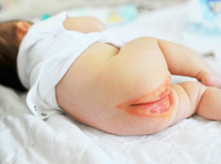 Nứt kẽ hậu môn ở trẻ có đáng lo? Nứt kẽ hậu môn ở trẻ có đáng lo?