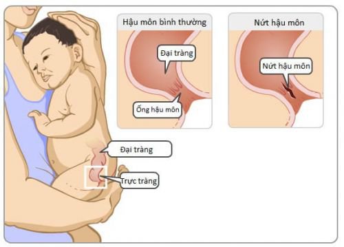Nứt kẽ hậu môn ở trẻ có đáng lo? Nứt kẽ hậu môn ở trẻ có đáng lo?