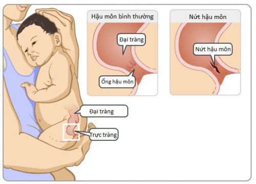 Nứt kẽ hậu môn ở trẻ có đáng lo?