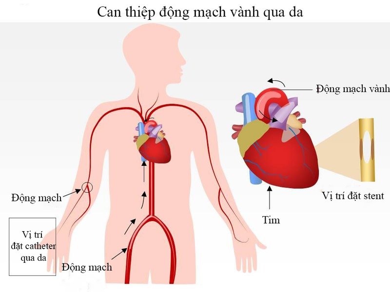 Can thiệp động mạch vành qua da