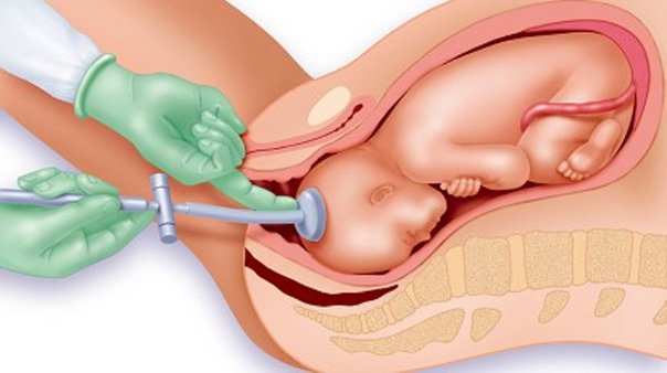Sinh con bằng giác hút có ảnh hưởng gì đến trẻ? Sinh con bằng giác hút có ảnh hưởng gì đến trẻ?