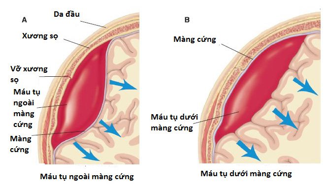 Máu tụ dưới màng cứng