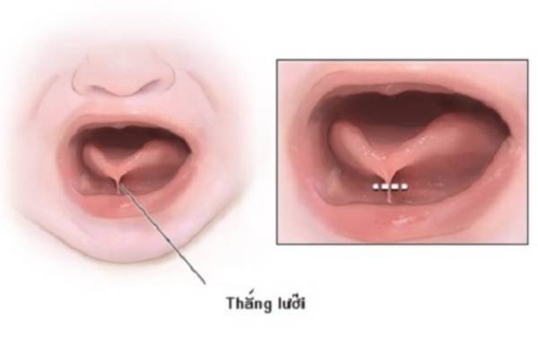 Xử trí tật dính thắng lưỡi ở trẻ nhỏ Xử trí tật dính thắng lưỡi ở trẻ nhỏ
