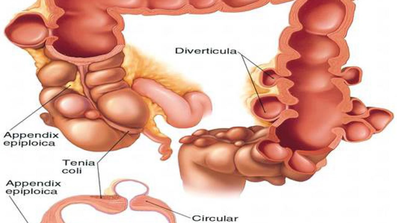 Bệnh túi thừa đại tràng điều trị thế nào?