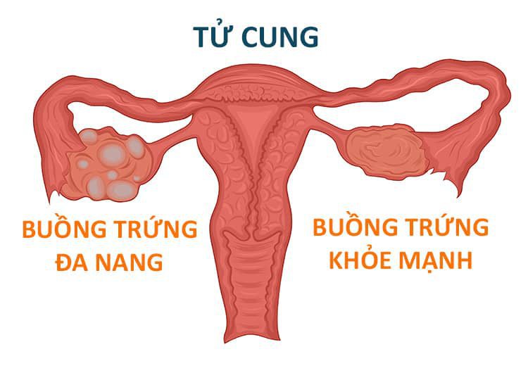 5 nguyên nhân gây đau ở buồng trứng, chẩn đoán, điều trị 5 nguyên nhân gây đau ở buồng trứng, chẩn đoán, điều trị