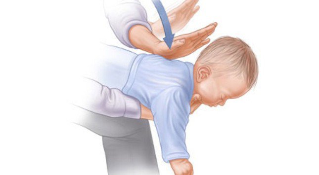 Sơ cứu trẻ hóc dị vật