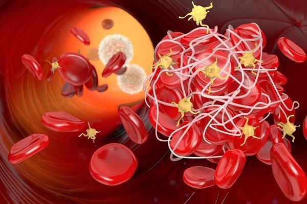 Phình động mạch có dấu hiệu nào cảnh báo không? Phình động mạch có dấu hiệu nào cảnh báo không?
