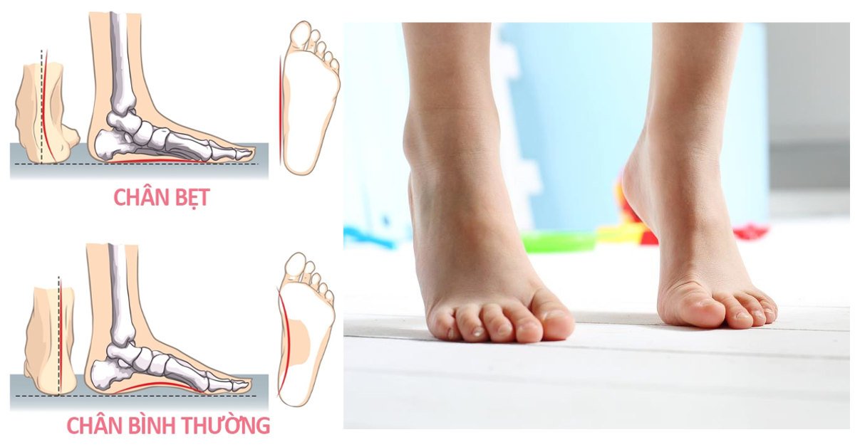 Bàn chân bẹt ở trẻ nhỏ có cần điều trị không? Bàn chân bẹt ở trẻ nhỏ có cần điều trị không?