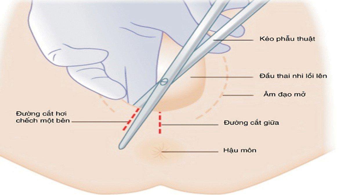 Đau sau cắt hoặc rách tầng sinh môn