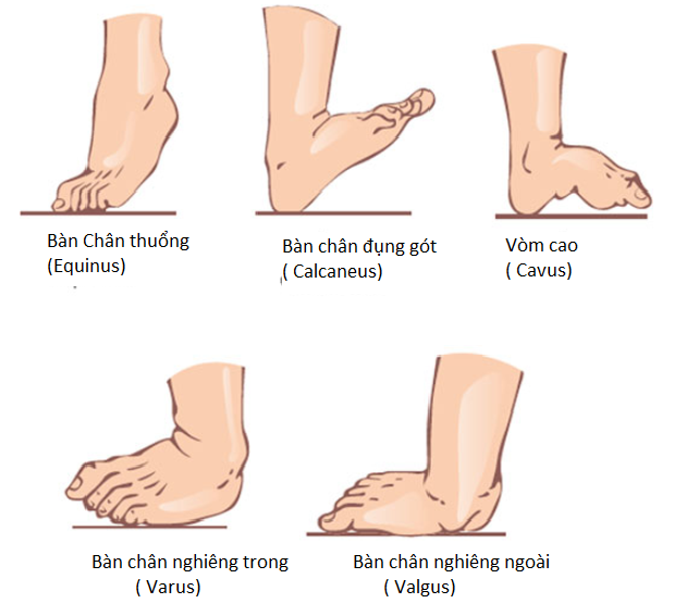 Dị tật bàn chân vẹo ở trẻ em Dị tật bàn chân vẹo ở trẻ em