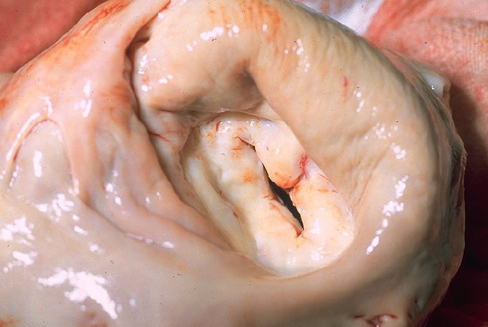Triển vọng cho những người bị hẹp van hai lá Triển vọng cho những người bị hẹp van hai lá