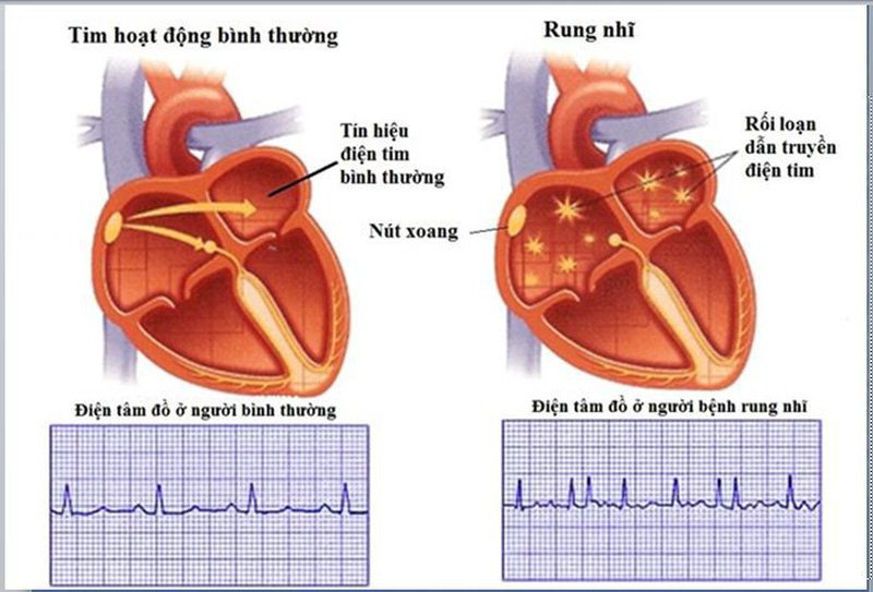 Triển vọng cho những người bị hẹp van hai lá Triển vọng cho những người bị hẹp van hai lá