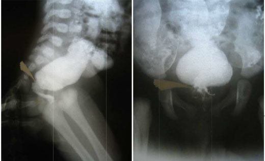 Chẩn đoán và điều trị phình đại tràng bẩm sinh ở trẻ Chẩn đoán và điều trị phình đại tràng bẩm sinh ở trẻ