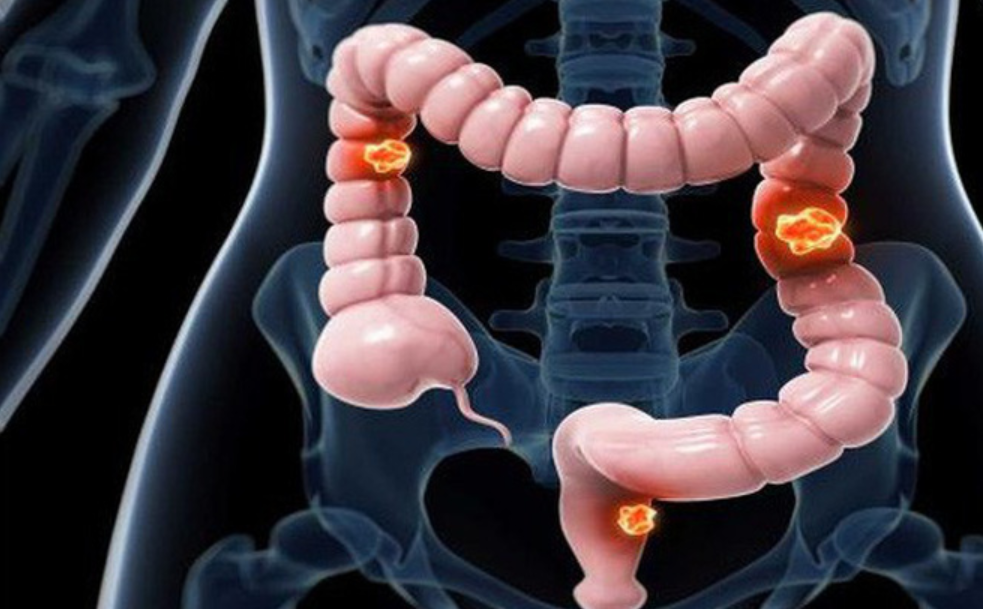 Ung thư đại trực tràng có chữa khỏi được không? | Vinmec