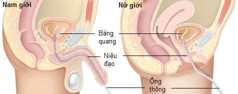 Lưu ý khi đặt thông tiểu Lưu ý khi đặt thông tiểu