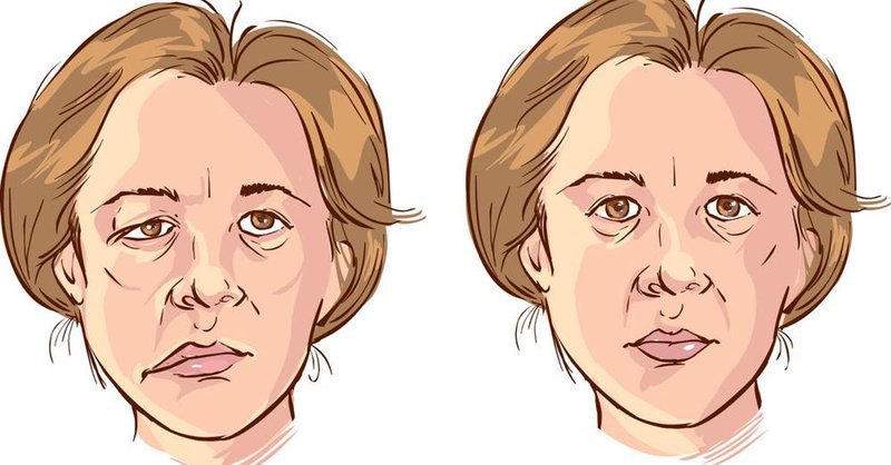 Chăm sóc, điều trị phục hồi chức năng ở người bị đột quỵ não Chăm sóc, điều trị phục hồi chức năng ở người bị đột quỵ não