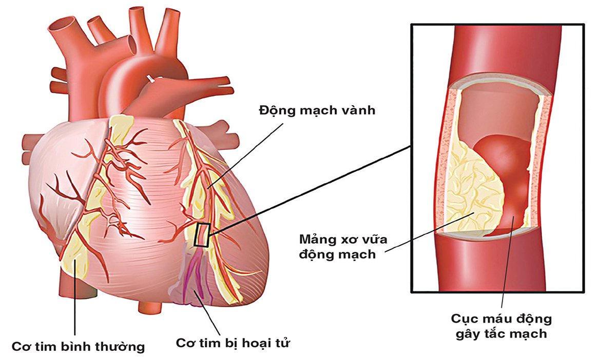 Canxi xuất hiện với lượng nhỏ trong các tổn thương xơ vữa động mạch sớm