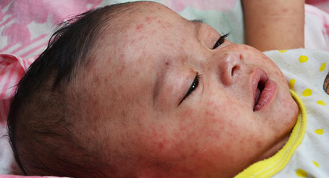 Rubella sởi