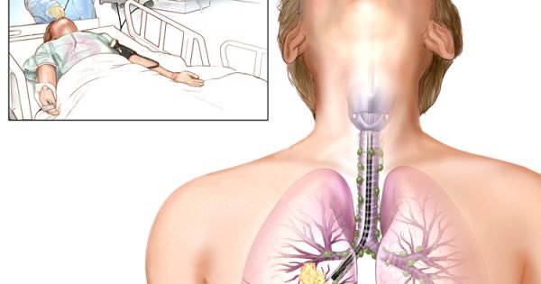 Nội soi phế quản: Phương pháp chẩn đoán các bệnh lý hô hấp Nội soi phế quản: Phương pháp chẩn đoán các bệnh lý hô hấp