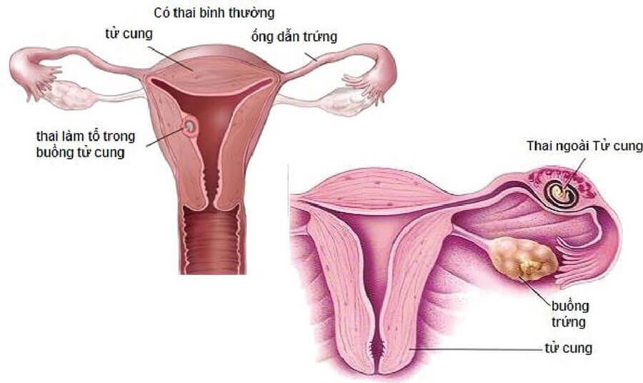 có thai ngoài tử cung