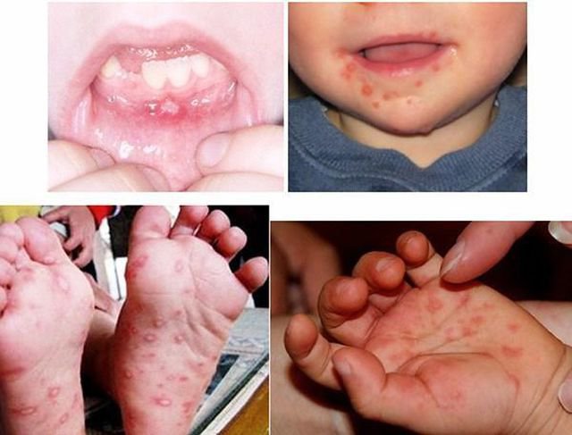Cảnh giác bệnh tay chân miệng, sốt xuất huyết vào mùa Cảnh giác bệnh tay chân miệng, sốt xuất huyết vào mùa