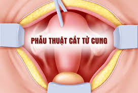 phẫu thuật cắt tử cung