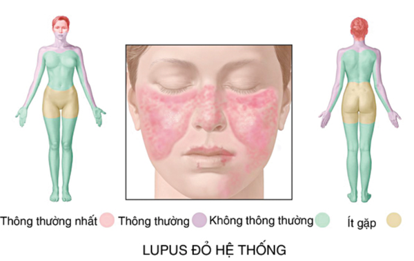 Bệnh Lupus ban đỏ hệ thống