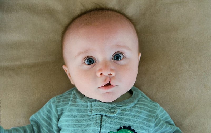 Khe hở môi hàm trên thường gặp bên nào? Khe hở môi hàm trên thường gặp bên nào?