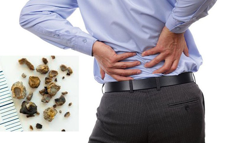 Các nguyên nhân gây đau quặn thận Các nguyên nhân gây đau quặn thận