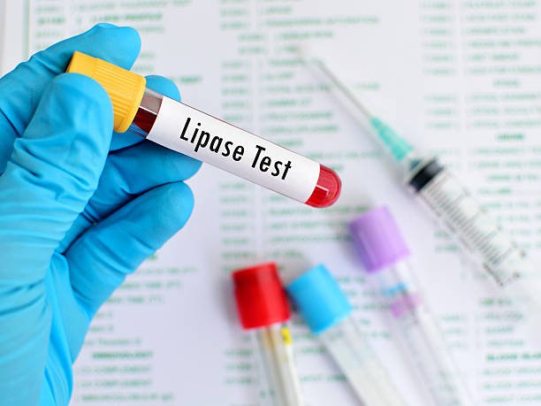 Xét nghiệm Lipase trong chẩn đoán các bệnh lý tuyến tụy Xét nghiệm Lipase trong chẩn đoán các bệnh lý tuyến tụy