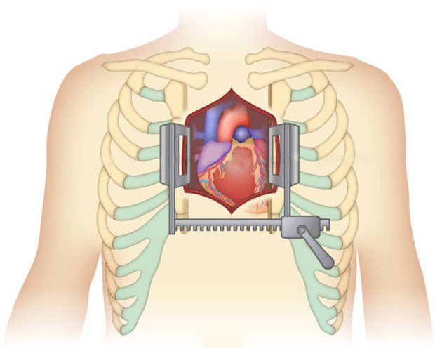 Chi phí cấy thiết bị hỗ trợ thất trái (LAVD) cho người suy tim Chi phí cấy thiết bị hỗ trợ thất trái (LAVD) cho người suy tim