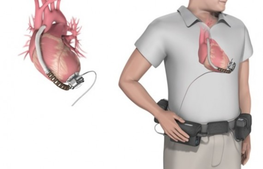 Chi phí cấy thiết bị hỗ trợ thất trái (LAVD) cho người suy tim Chi phí cấy thiết bị hỗ trợ thất trái (LAVD) cho người suy tim