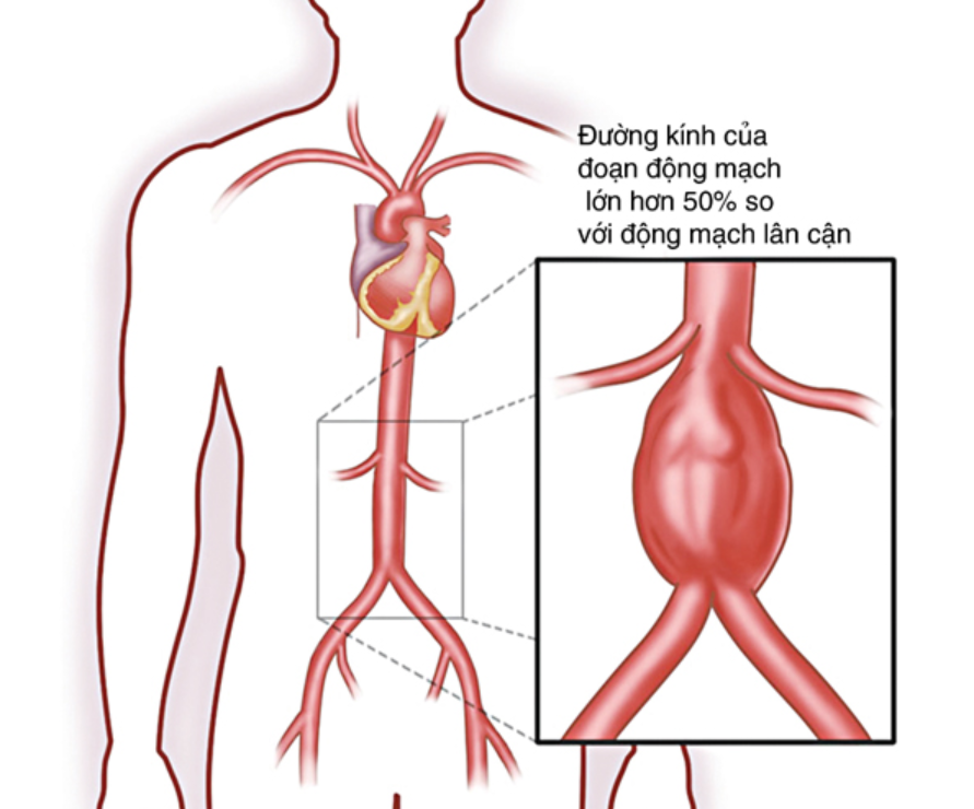 Phình động mạch chủ ảnh hưởng đến các cơ quan khác như thế nào? Phình động mạch chủ ảnh hưởng đến các cơ quan khác như thế nào?