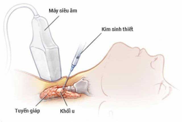 Những điều bạn nên biết về bướu nhân tuyến giáp Những điều bạn nên biết về bướu nhân tuyến giáp