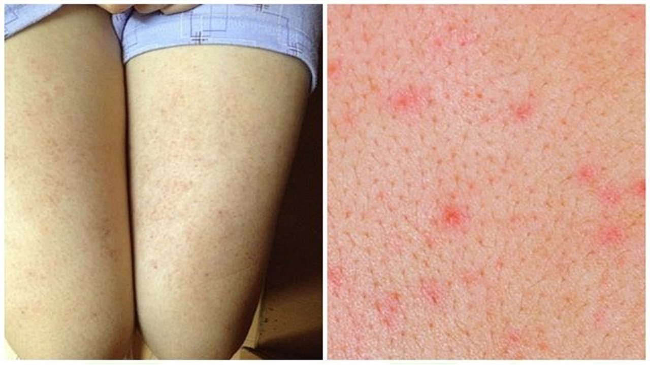 How long does it take to treat folliculitis? Vinmec