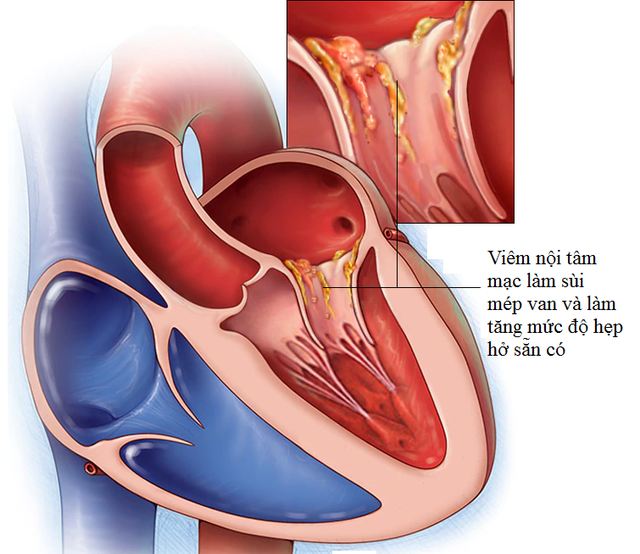 Biến chứng của bệnh sa van 2 lá Biến chứng của bệnh sa van 2 lá