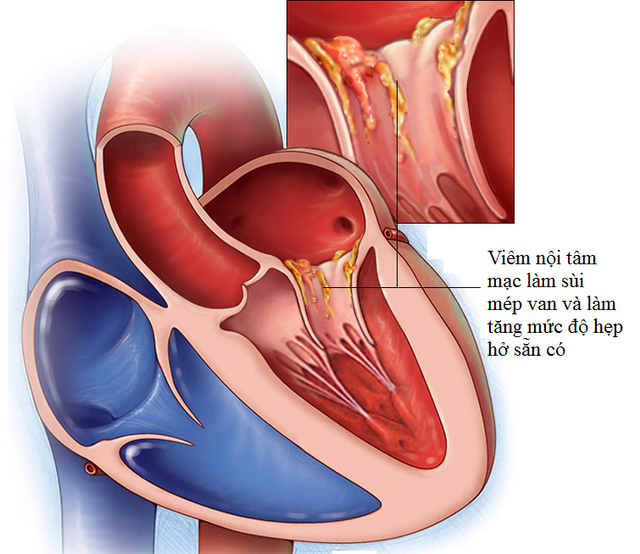 Viêm nội tâm mạc