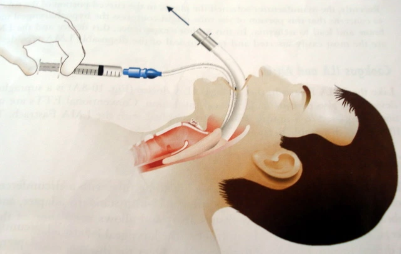Placing a laryngeal mask in airway emergency Vinmec