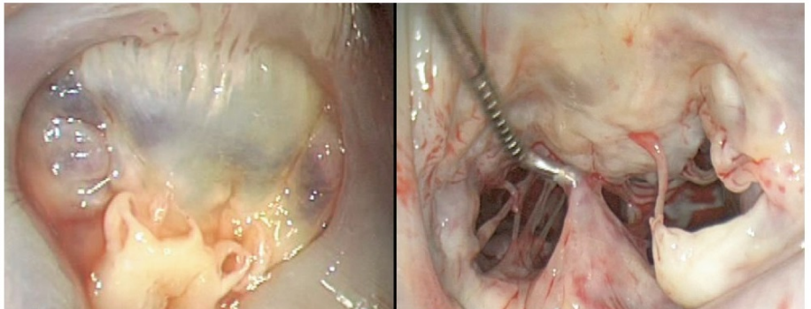 Thiếu xơ chun van 2 lá (fibroelastic deficiency)