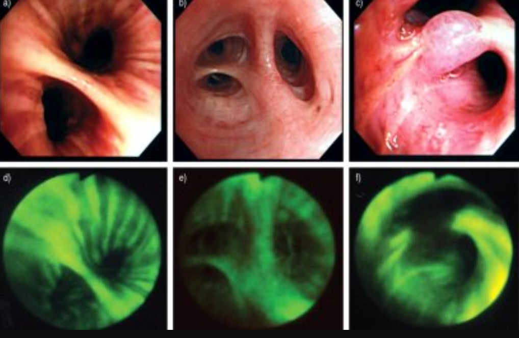 Hình ảnh nội soi phế quản với ánh sáng huỳnh quang
