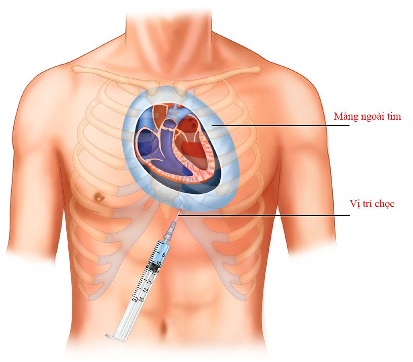 Viêm mủ màng ngoài tim có nguy hiểm? Viêm mủ màng ngoài tim có nguy hiểm?