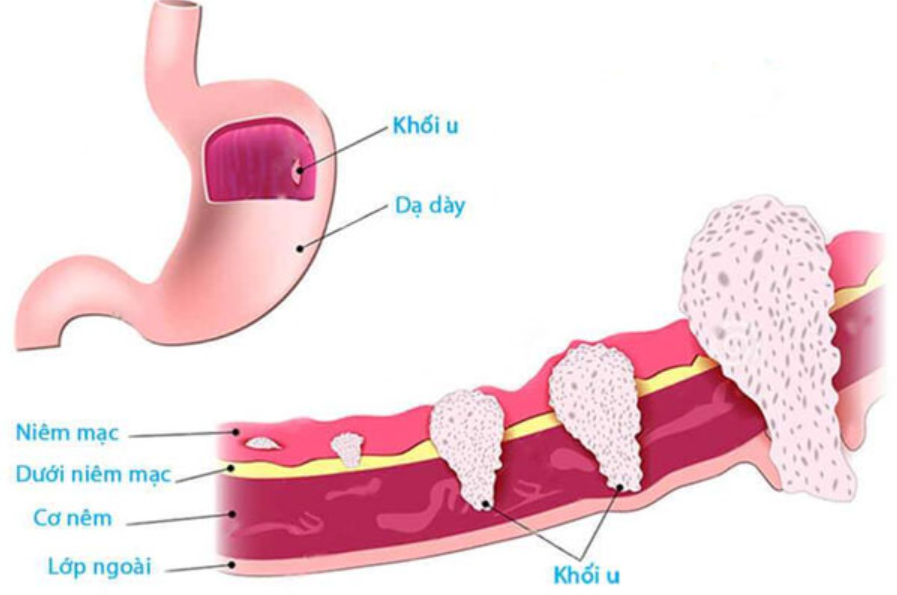 Cắt dạ dày do ung thư: Những điều cần lưu ý Cắt dạ dày do ung thư: Những điều cần lưu ý