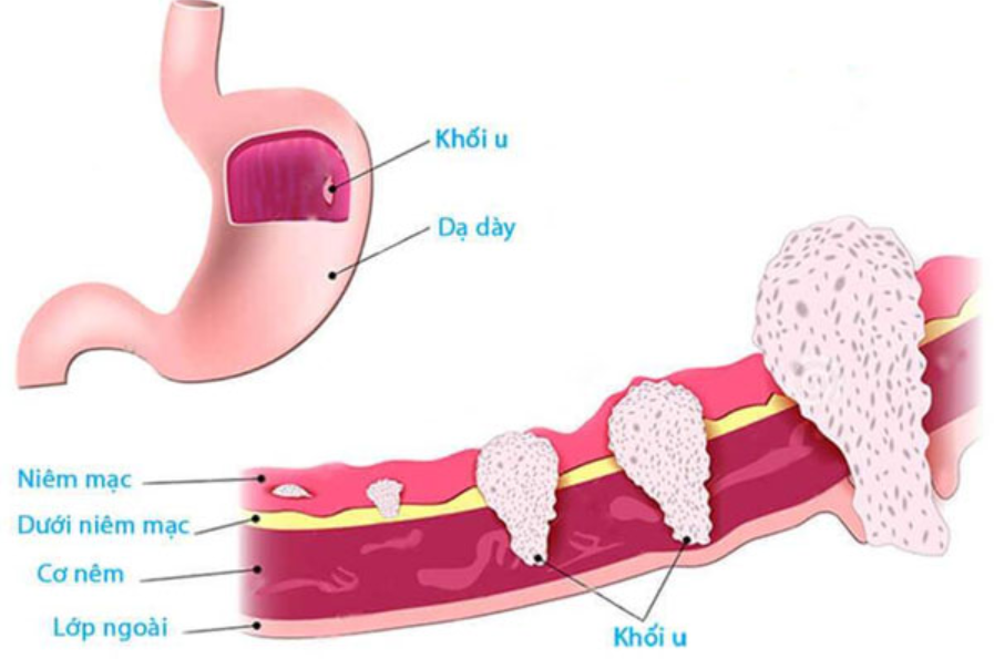 ung thư dạ dày