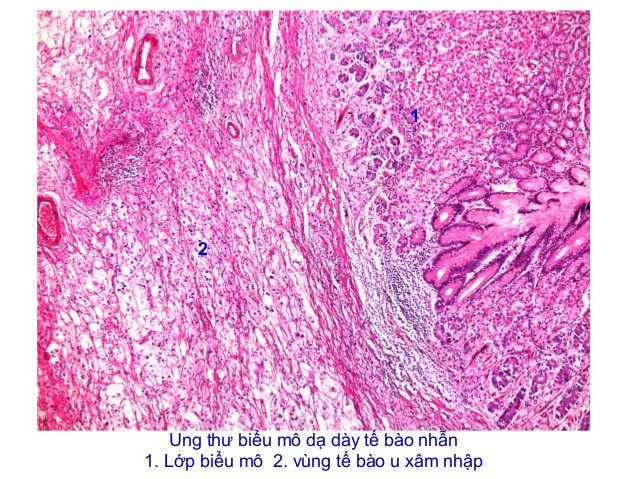 Tái phát sau phẫu thuật cắt dạ dày do ung thư