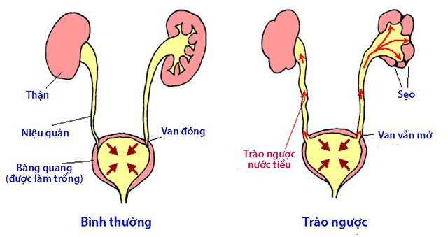 Phẫu thuật nội soi cắm lại 2 niệu quản điều trị luồng trào ngược bàng quang - niệu quản bẩm sinh Phẫu thuật nội soi cắm lại 2 niệu quản điều trị luồng trào ngược bàng quang - niệu quản bẩm sinh